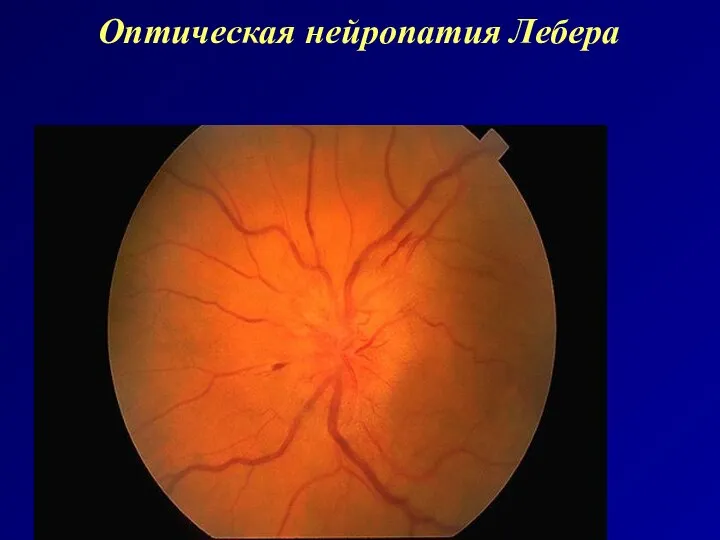 Оптическая нейропатия Лебера