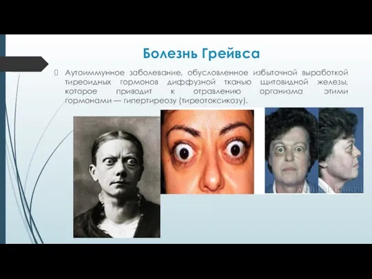 Болезнь Грейвса Аутоиммунное заболевание, обусловленное избыточной выработкой тиреоидных гормонов диффузной тканью щитовидной