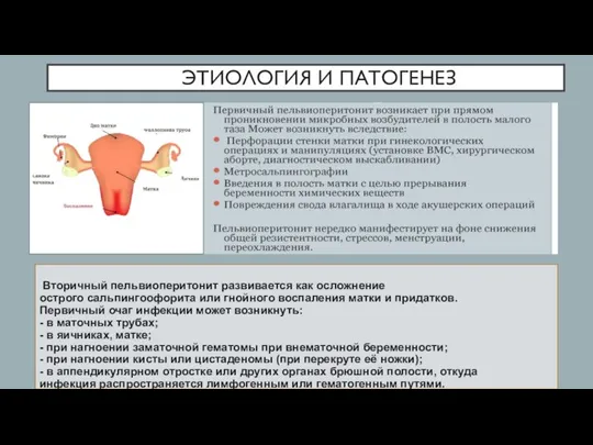 ЭТИОЛОГИЯ И ПАТОГЕНЕЗ Вторичный пельвиоперитонит развивается как осложнение острого сальпингоофорита или гнойного