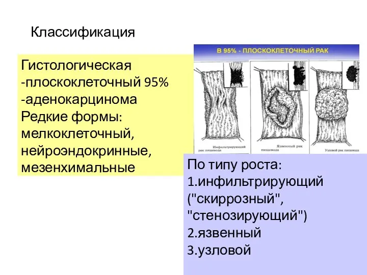 Классификация Гистологическая -плоскоклеточный 95% -аденокарцинома Редкие формы: мелкоклеточный, нейроэндокринные, мезенхимальные По типу