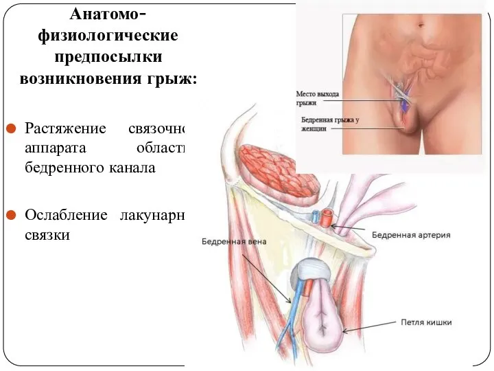 Анатомо-физиологические предпосылки возникновения грыж: Растяжение связочного аппарата области бедренного канала Ослабление лакунарной связки