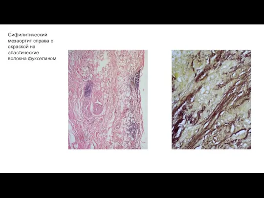 Сифилитический мезаортит справа с окраской на эластические волокна фукселином