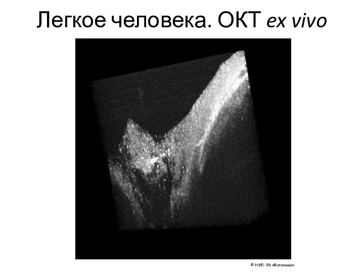 Легкое человека. ОКТ ex vivo © НИЛ-96 «Фотоника»