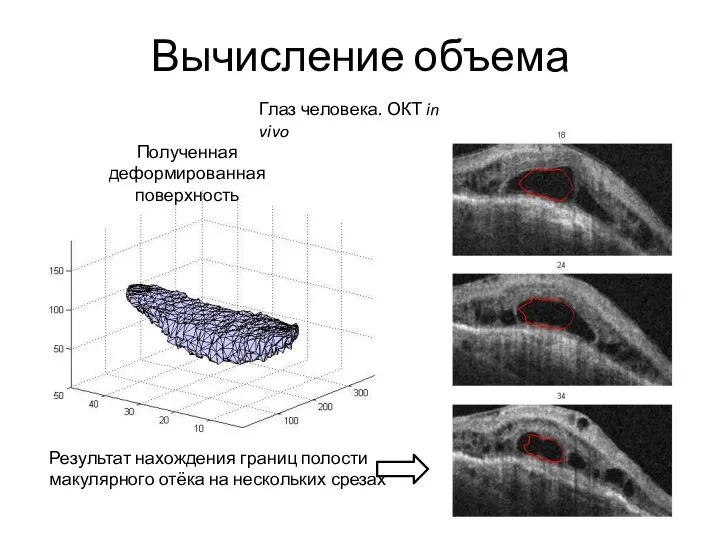 Вычисление объема Результат нахождения границ полости макулярного отёка на нескольких срезах Полученная