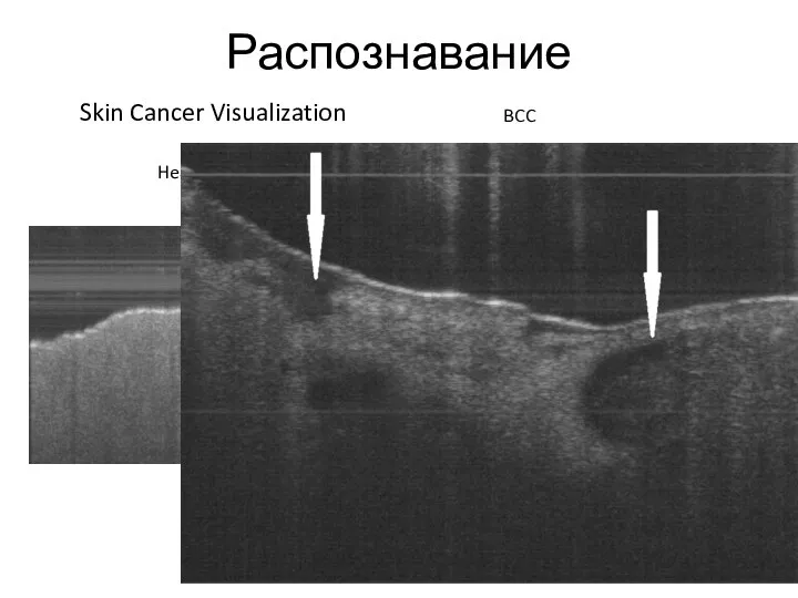 Распознавание Skin Cancer Visualization Healthy tissue