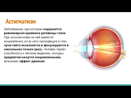 Астигматизм Заболевание, при котором нарушается равномерная кривизна роговицы глаза. При астигматизме на
