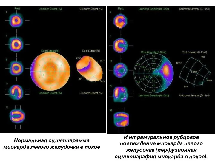 Нормальная сцинтиграмма миокарда левого желудочка в покое И нтрамуральное рубцовое повреждение миокарда