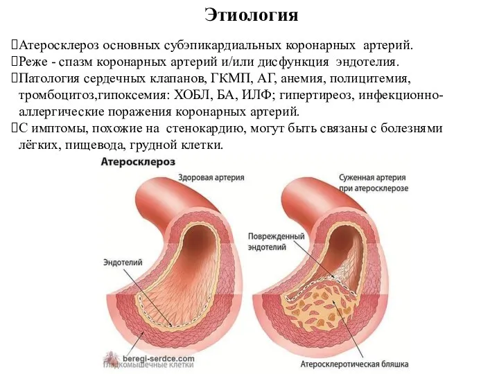 Этиология Атеросклероз основных субэпикардиальных коронарных артерий. Реже - спазм коронарных артерий и/или