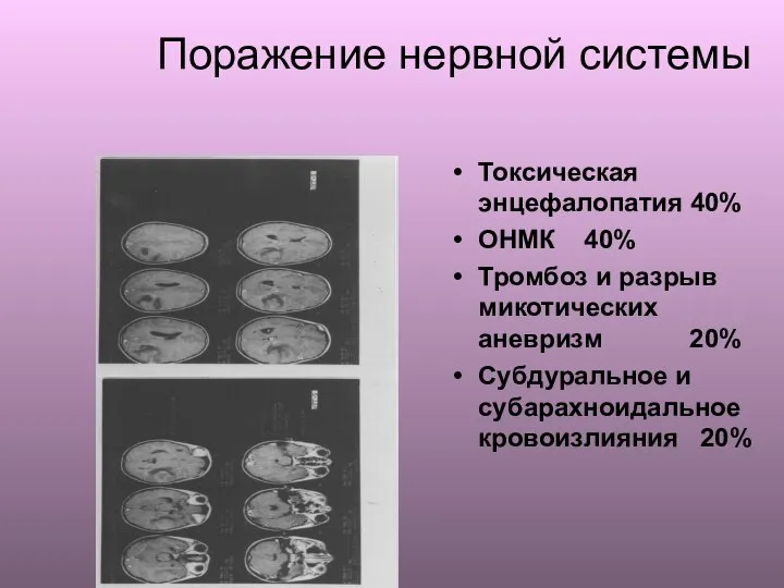 Поражение нервной системы Токсическая энцефалопатия 40% ОНМК 40% Тромбоз и разрыв микотических