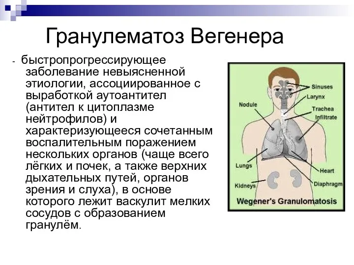 Гранулематоз Вегенера - быстропрогрессирующее заболевание невыясненной этиологии, ассоциированное с выработкой аутоантител (антител