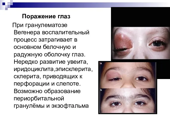 Поражение глаз При гранулематозе Вегенера воспалительный процесс затрагивает в основном белочную и