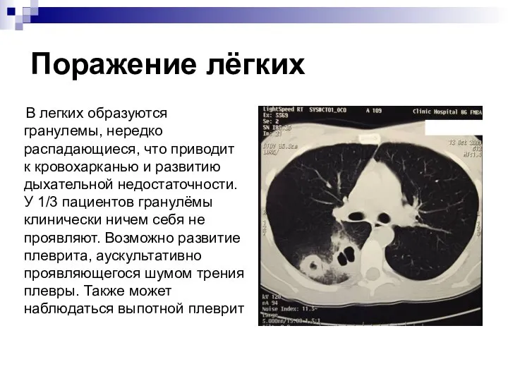 Поражение лёгких В легких образуются гранулемы, нередко распадающиеся, что приводит к кровохарканью