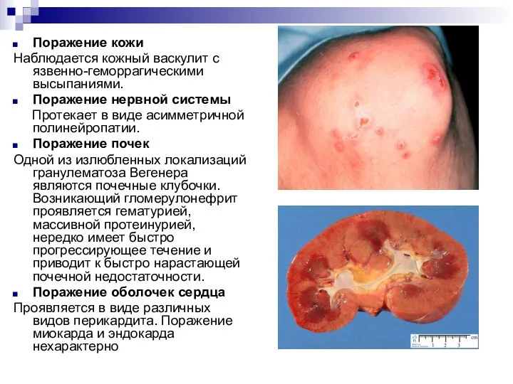 Поражение кожи Наблюдается кожный васкулит с язвенно-геморрагическими высыпаниями. Поражение нервной системы Протекает