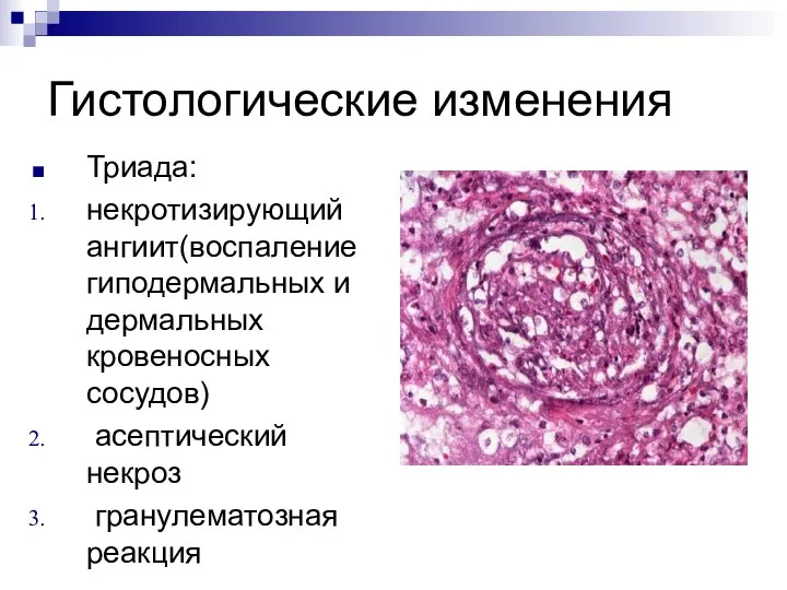 Гистологические изменения Триада: некротизирующий ангиит(воспаление гиподермальных и дермальных кровеносных сосудов) асептический некроз гранулематозная реакция