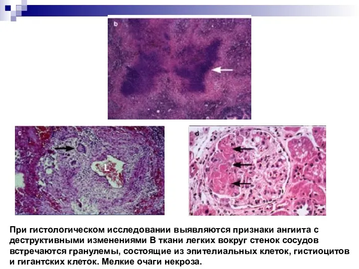 При гистологическом исследовании выявляются признаки ангиита с деструктивными изменениями В ткани легких