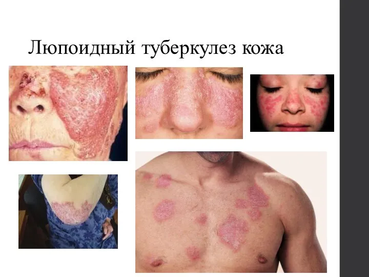 Люпоидный туберкулез кожа