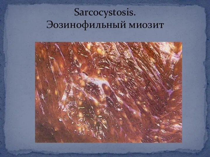 Sarcocystosis. Эозинофильный миозит