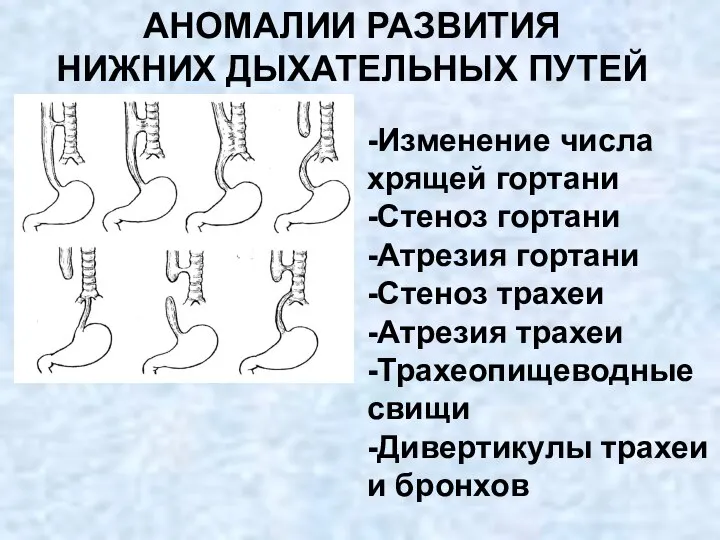 АНОМАЛИИ РАЗВИТИЯ НИЖНИХ ДЫХАТЕЛЬНЫХ ПУТЕЙ -Изменение числа хрящей гортани -Стеноз гортани -Атрезия