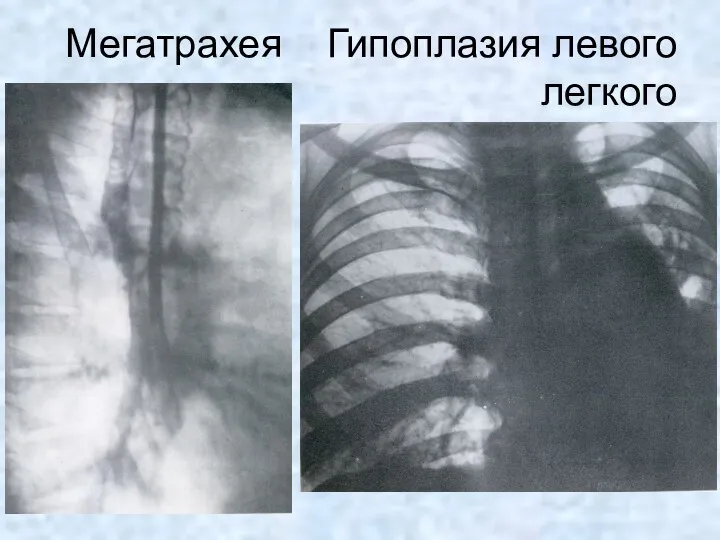 Мегатрахея Гипоплазия левого легкого