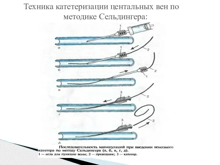 Техника катетеризации центальных вен по методике Сельдингера: