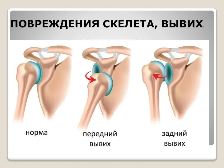 ПОВРЕЖДЕНИЯ СКЕЛЕТА, ВЫВИХ.