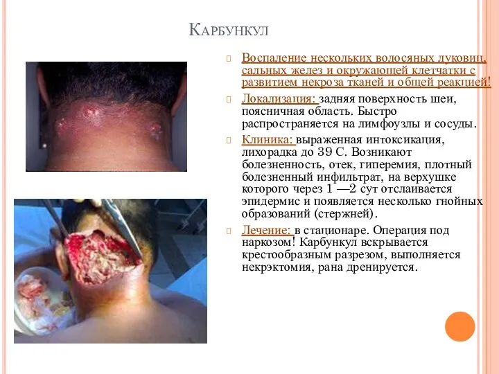 Карбункул Воспаление нескольких волосяных луковиц, сальных желез и окружающей клетчатки с развитием