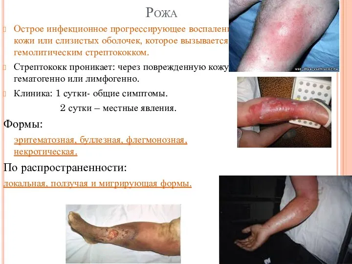 Рожа Острое инфекционное прогрессирующее воспаление кожи или слизистых оболочек, которое вызывается гемолитическим