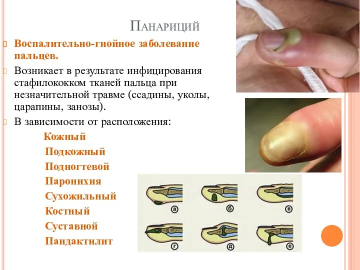 Панариций Воспалительно-гнойное заболевание пальцев. Возникает в результате инфицирования стафилококком тканей пальца при