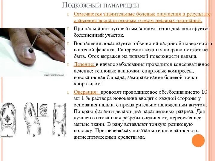 Подкожный панариций Отмечаются значительные болевые ощущения в результате сдавления воспалительным отеком нервных