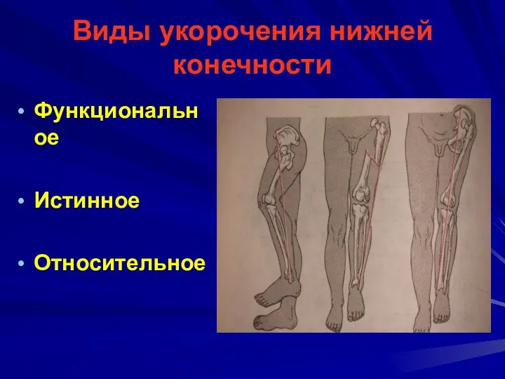 Виды укорочения нижней конечности Функциональное Истинное Относительное