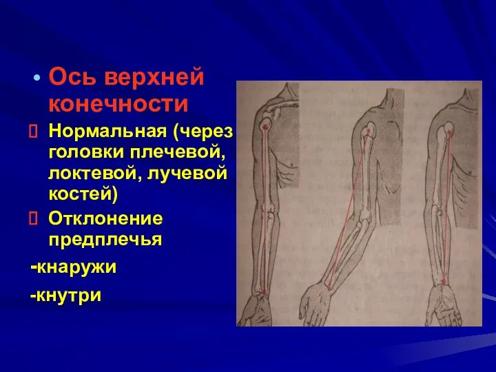 Ось верхней конечности Нормальная (через головки плечевой, локтевой, лучевой костей) Отклонение предплечья -кнаружи -кнутри