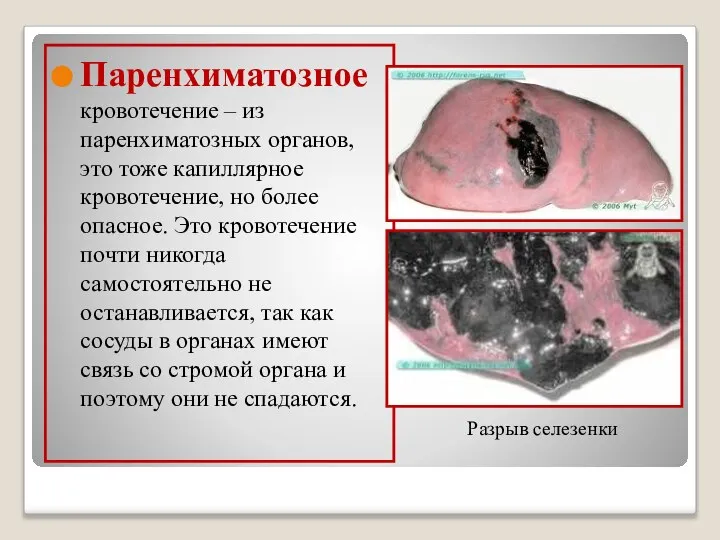 Паренхиматозное кровотечение – из паренхиматозных органов, это тоже капиллярное кровотечение, но более