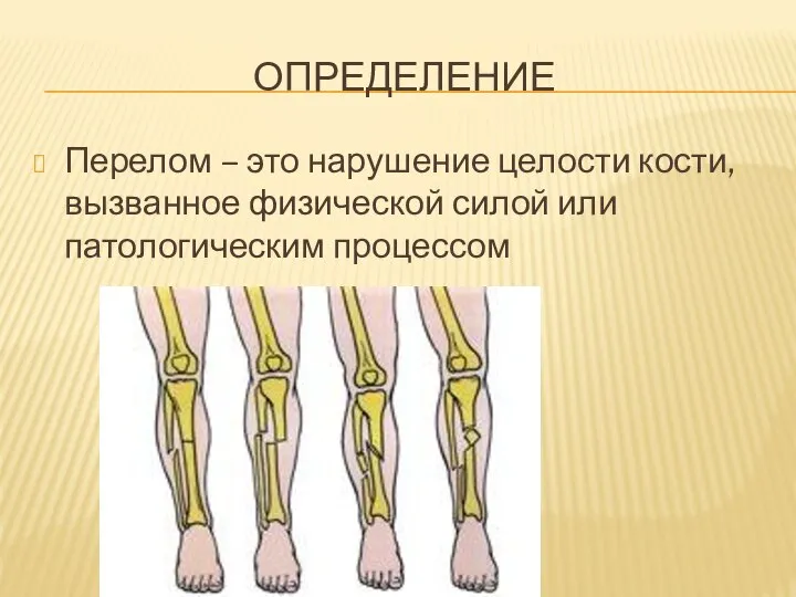 ОПРЕДЕЛЕНИЕ Перелом – это нарушение целости кости, вызванное физической силой или патологическим процессом