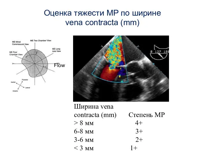 Ширина vena contracta (mm) Степень МР > 8 мм 4+ 6-8 мм