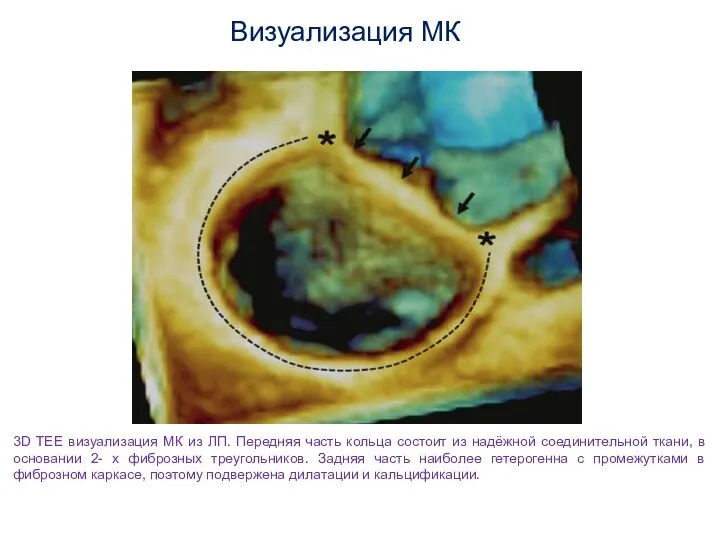 3D TEE визуализация МК из ЛП. Передняя часть кольца состоит из надёжной