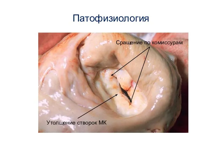 Патофизиология Утолщение створок МК Сращение по комиссурам
