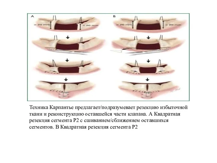 Техника Карпантье предлагает/подразумевает резекцию избыточной ткани и реконструкцию оставшейся части клапана. А