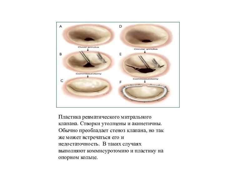 Пластика ревматического митрального клапана. Створки утолщены и акинетичны. Обычно преобладает стеноз клапана,