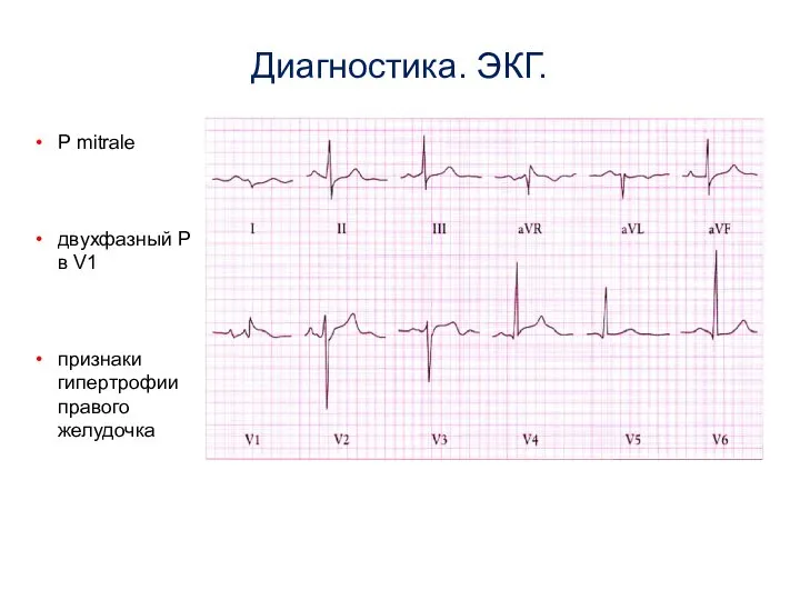 Диагностика. ЭКГ. P mitrale двухфазный P в V1 признаки гипертрофии правого желудочка