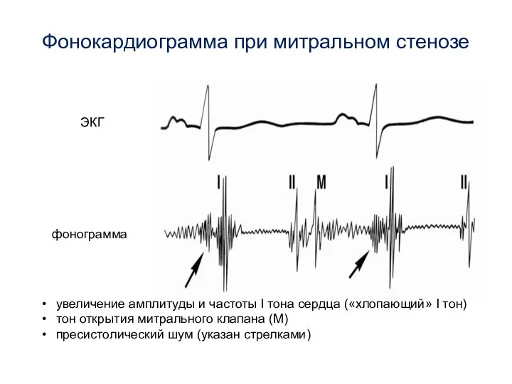 Фонокардиограмма при митральном стенозе ЭКГ фонограмма увеличение амплитуды и частоты I тона
