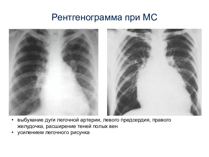 Рентгенограмма при МС выбухание дуги легочной артерии, левого предсердия, правого желудочка, расширение