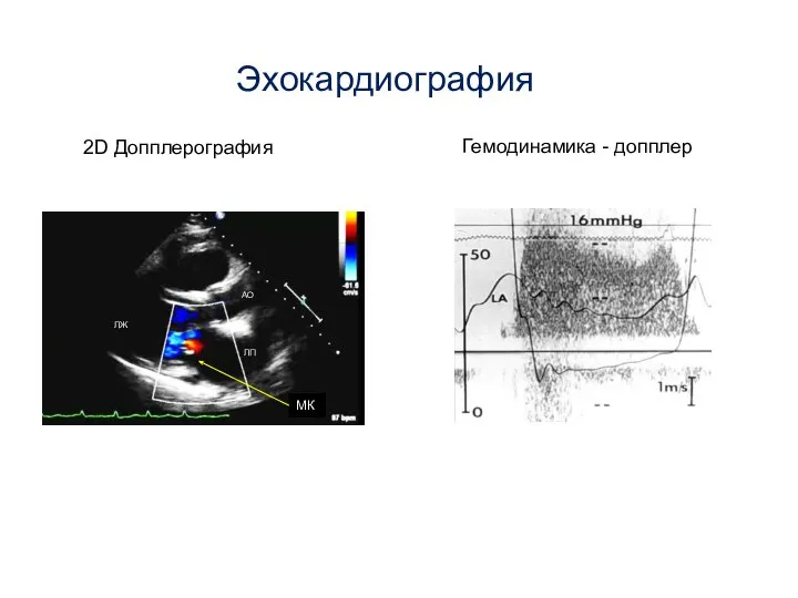 Эхокардиография 2D Допплерография Гемодинамика - допплер