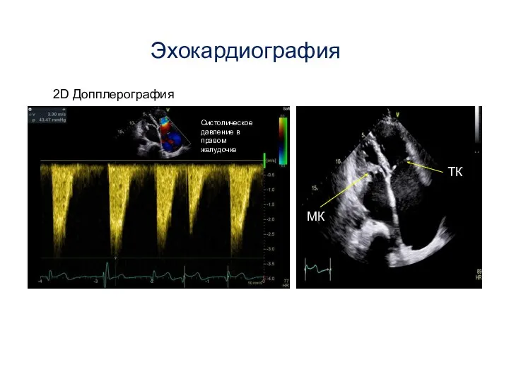 Эхокардиография 2D Допплерография Систолическое давление в правом желудочке