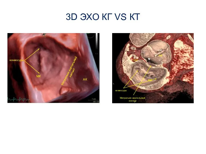 3D ЭХО КГ VS КТ