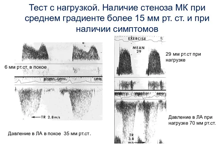 Тест с нагрузкой. Наличие стеноза МК при среднем градиенте более 15 мм