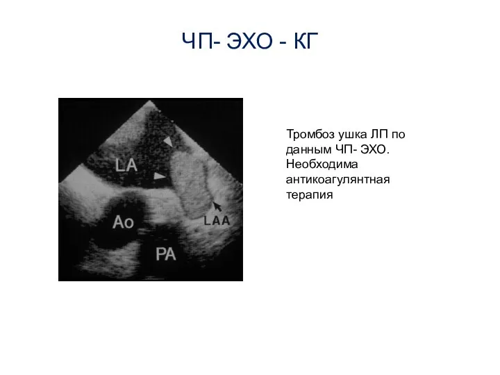 ЧП- ЭХО - КГ Тромбоз ушка ЛП по данным ЧП- ЭХО. Необходима антикоагулянтная терапия