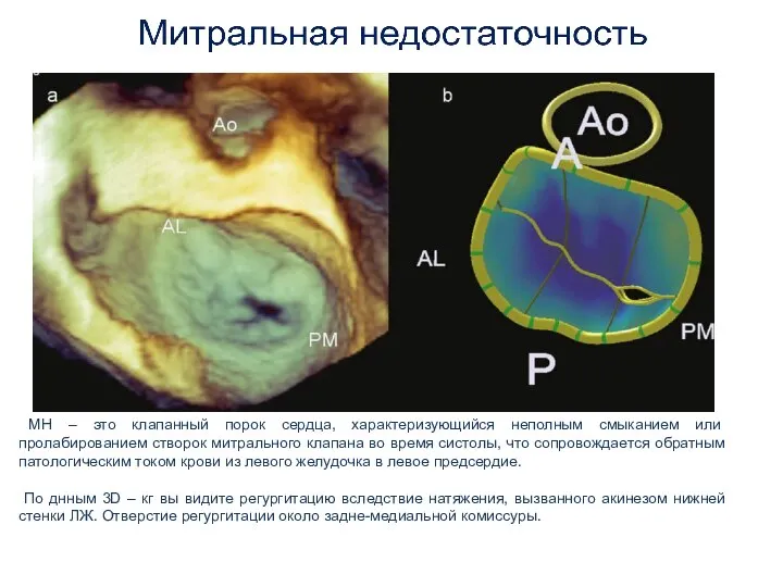 МН – это клапанный порок сердца, характеризующийся неполным смыканием или пролабированием створок