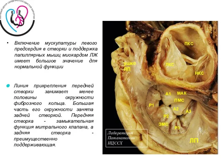 Включение мускулатуры левого предсердия в створки и поддержка папиллярных мышц миокардом ЛЖ