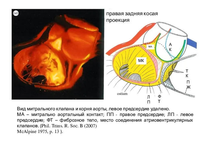 Вид митрального клапана и корня аорты, левое предсердие удалено. МА – митрально