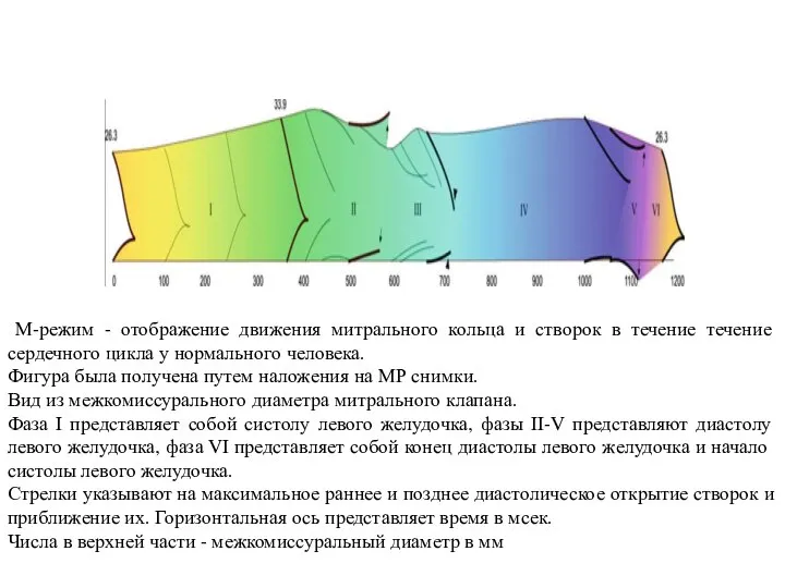 М-режим - отображение движения митрального кольца и створок в течение течение сердечного